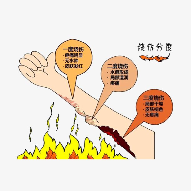 三度烧伤不植皮可以吗