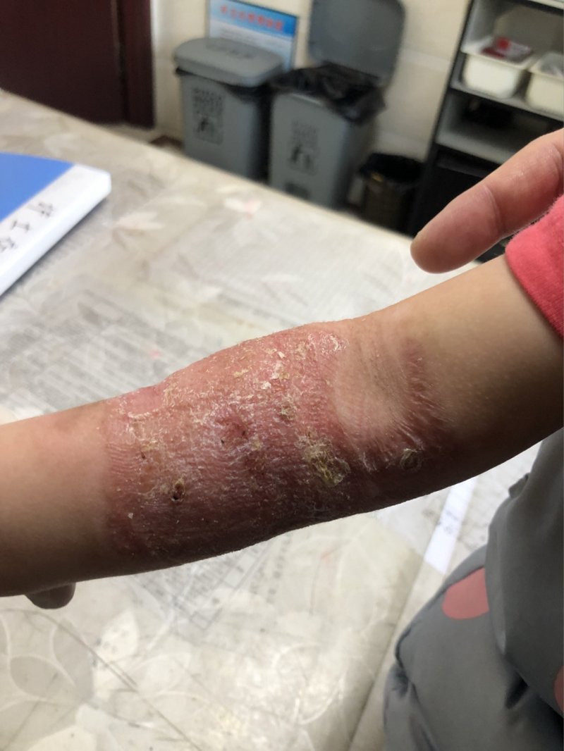 三度烫伤不植皮能好吗