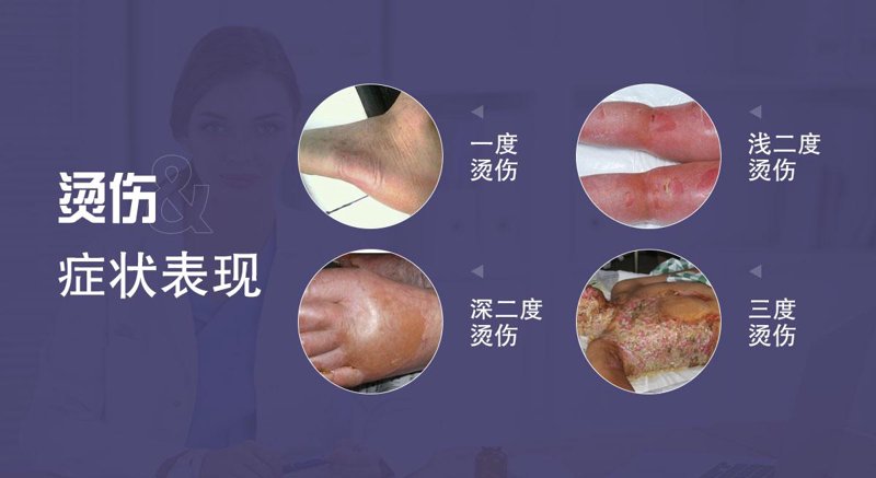 三度烫伤怎么治疗